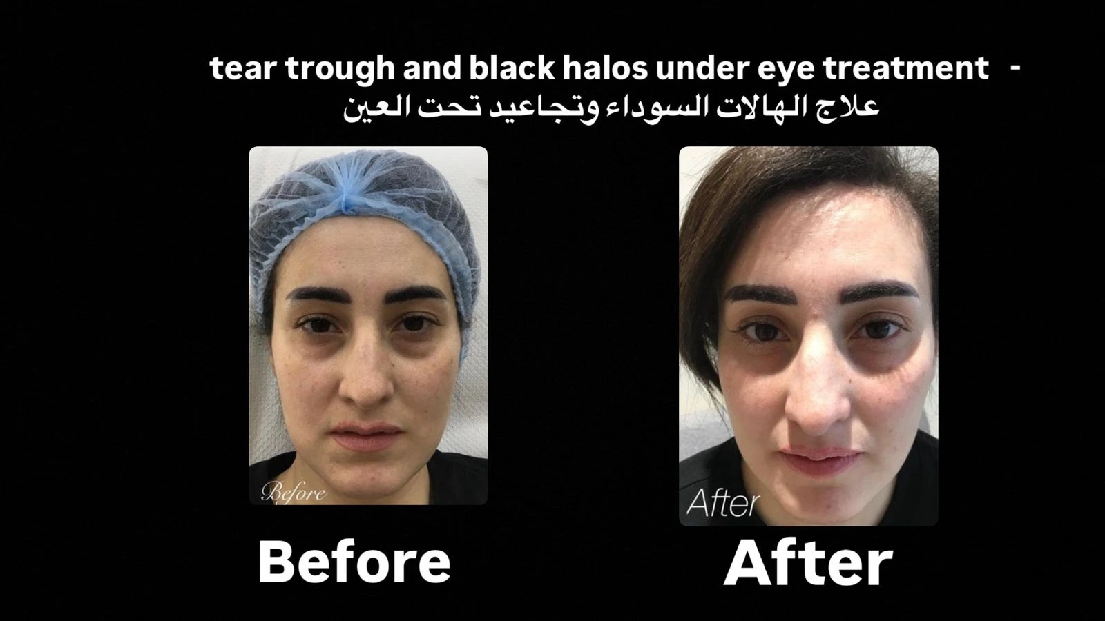 Patient testimonial for Botox treatment