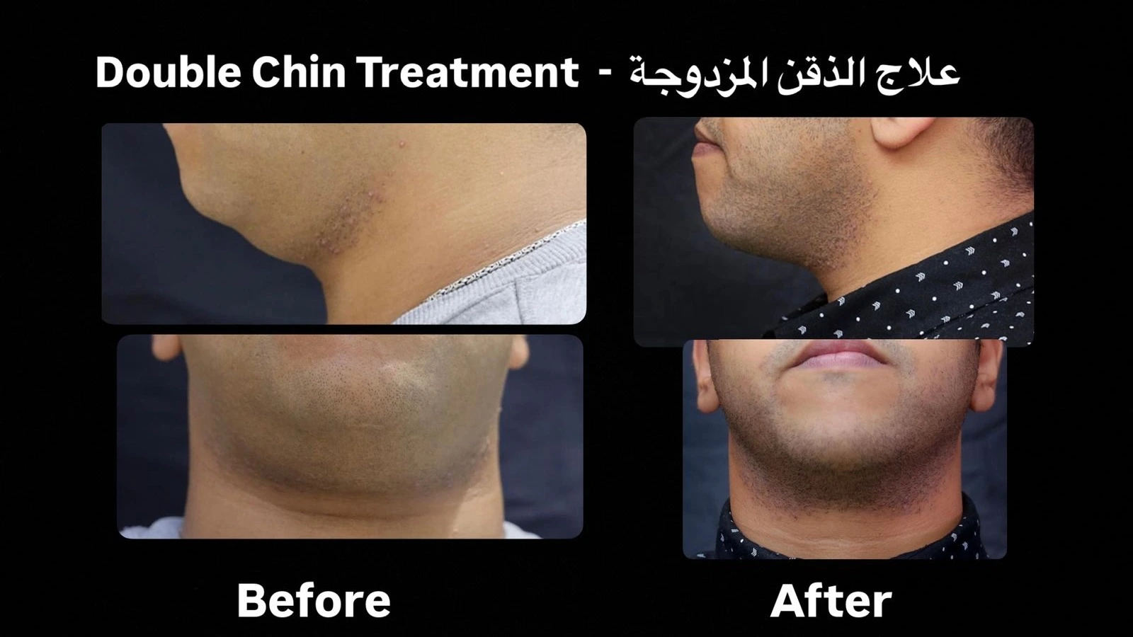 Patient review for Rhinoplasty