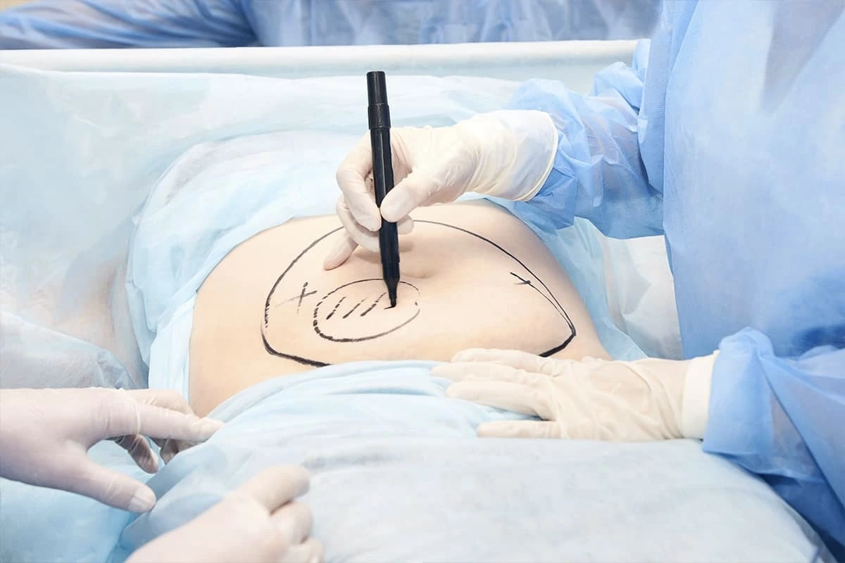 Abdominoplasty Tummy Tuck Cairo Egypt - Dr. Khaled Elsherbiny