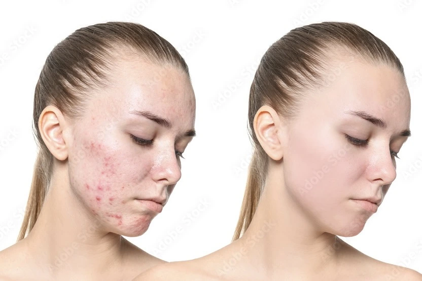 Acne Scars Treatment Cairo Egypt - Dr. Khaled Elsherbiny Skin Resurfacing