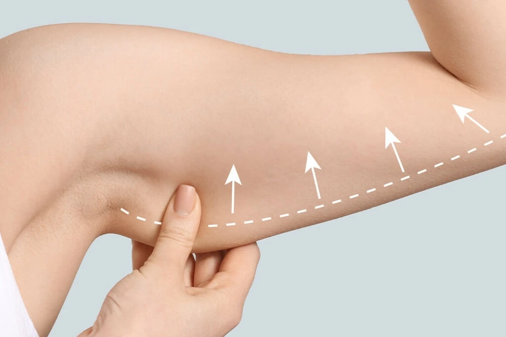 Brachioplasty Arm Lift Cairo Egypt - Dr. Khaled Elsherbiny