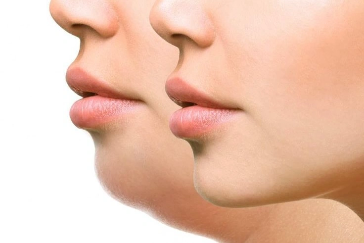 Double Chin Treatment Cairo Egypt - Dr. Khaled Elsherbiny Submental Liposuction
