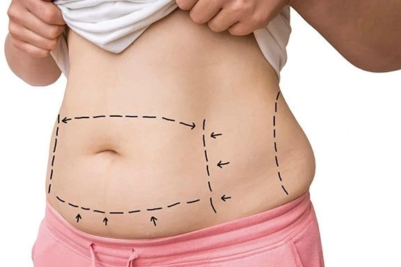 Liposuction Cairo Egypt - Dr. Khaled Elsherbiny Body Contouring Fat Removal