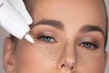 Plasma Therapy PRP Treatment Cairo Egypt - Dr. Khaled Elsherbiny